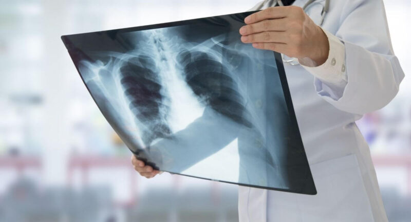 心不全の検査の胸部X線画像のイメージ画像